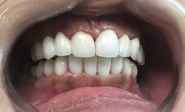 A completed Ultratooth restoration in place