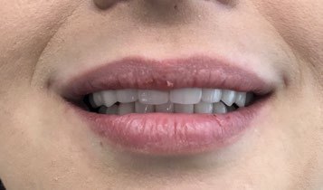 The same patient's smile restored