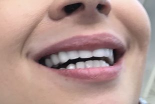 A patient's smile with a missing upper tooth